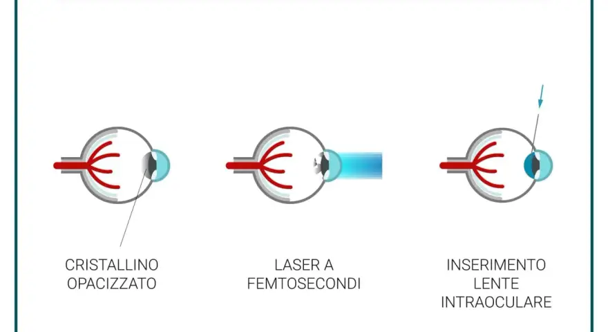 Chirurgia della cataratta con laser: illustra cristallino opacizzato, laser a femtosecondi e inserimento lente intraoculare. Valutare sempre le controindicazioni.