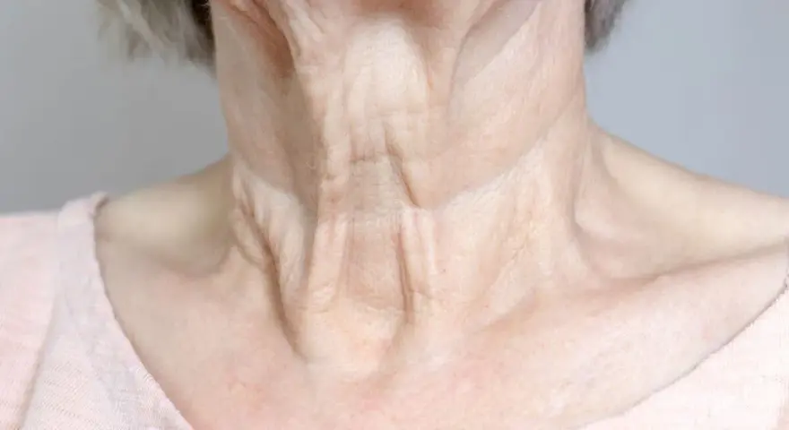 Primer plano del cuello flácido de una mujer mayor, mostrando arrugas y pliegues pronunciados.