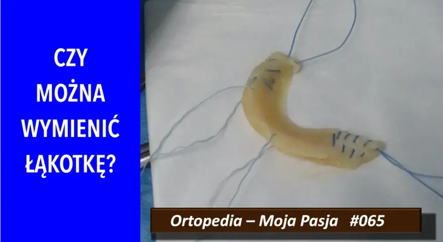 Implant łąkotki NFZ. Czy można wymienić łąkotkę? Ortopedia – Moja Pasja #065.