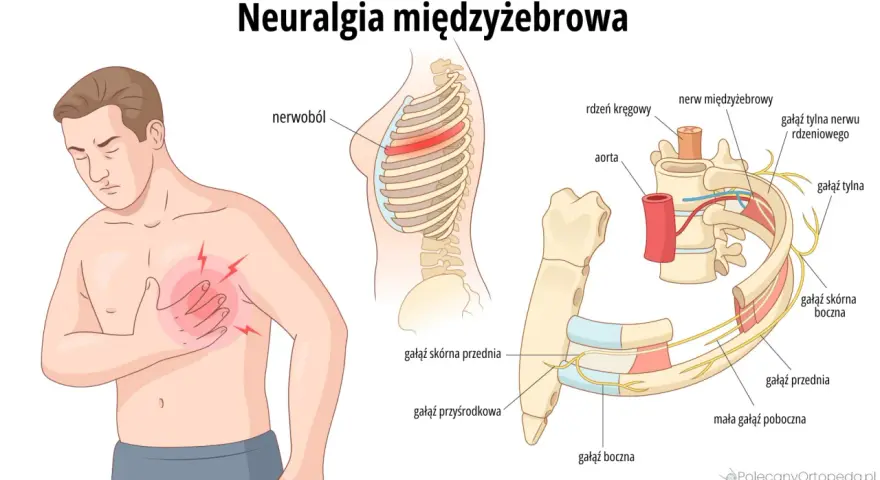 Człowiek z bólem w klatce piersiowej, ilustracja anatomii żeber i nerwów. Głębokie wdechy na tle nerwowym.