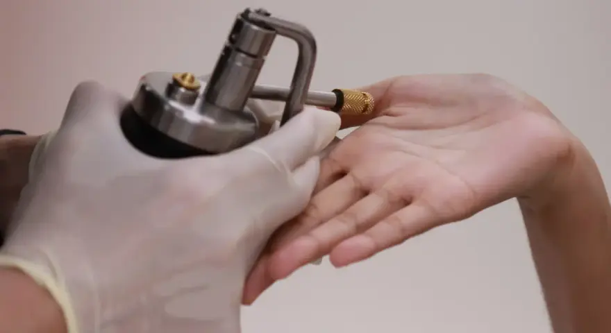 Application d'azote liquide sur une verrue pour un traitement par cryothérapie.