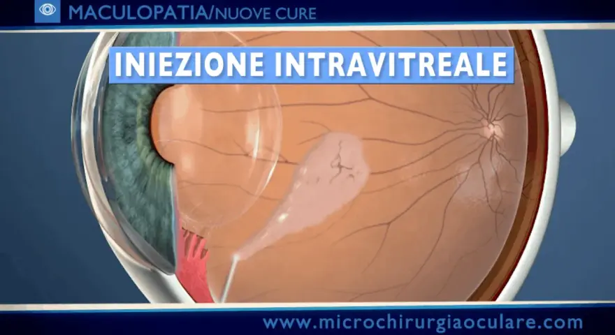 Iniezione intravitreale per trattare l'emorragia maculare. La macula, colpita da un'anomalia, riceve il farmaco.