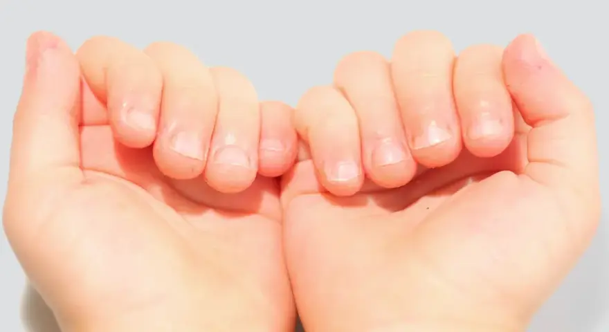 Mains d'enfant montrant des ongles rongés, avec des cuticules irrégulières et des bords d'ongles abîmés.