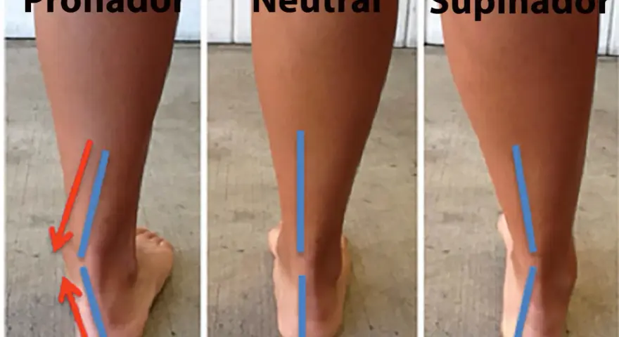 Comparación de pisadas: pronador, neutral y supinador. El desgaste de zapatillas varía según el tipo de pisada.