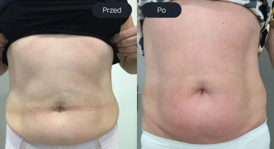 Porównanie brzucha przed i po endermologii. Widoczne wygładzenie skóry i redukcja tkanki tłuszczowej – spektakularne endermologia brzuch efekty.