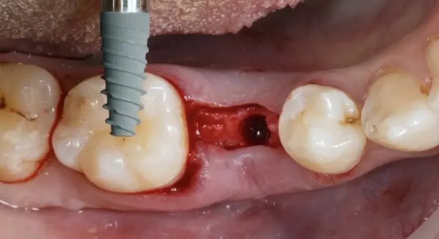 Kiedy implant po wyrwaniu zęba? Poznaj kluczowe terminy i ryzyka