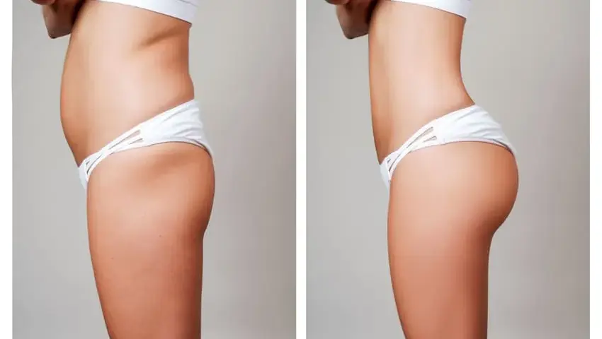 Liposukcja: Kompleksowy przewodnik po zabiegu i kosztach w Polsce