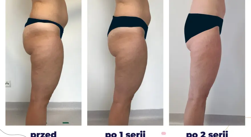 Efekty zabiegu iCoone na uda: przed, po 1 i po 2 seriach. Widoczna redukcja cellulitu i poprawa jędrności skóry.