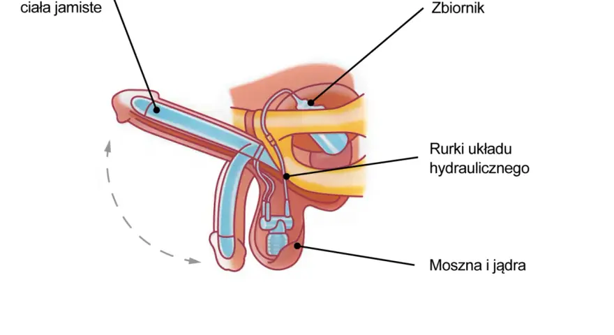 Schemat protezy penisa, która umożliwia erekcję dzięki hydraulicznemu układowi.