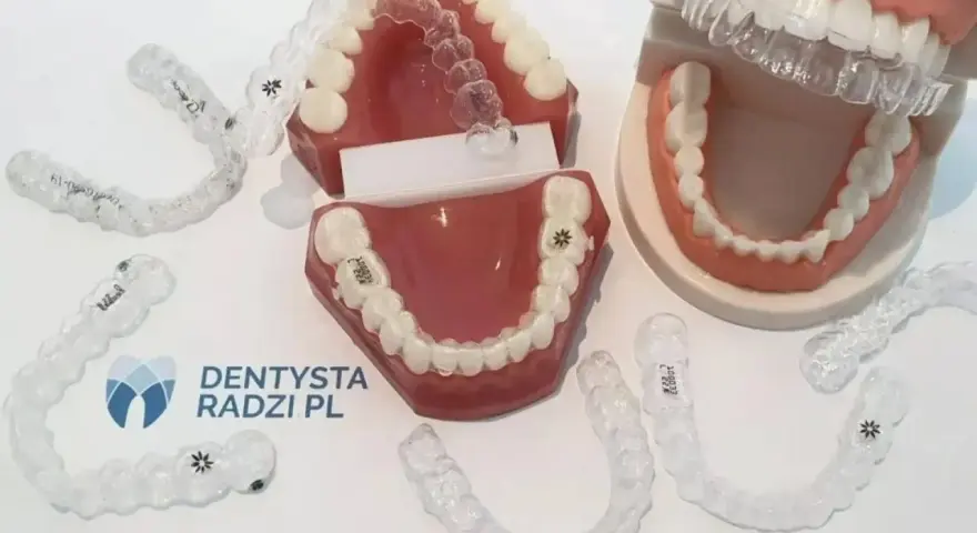 Aparat na jeden łuk? Kiedy to możliwe i czy warto ryzykować?