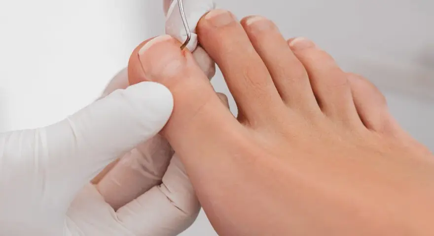 Jak zrobić tamponadę paznokcia? Ulga od wrastania krok po kroku