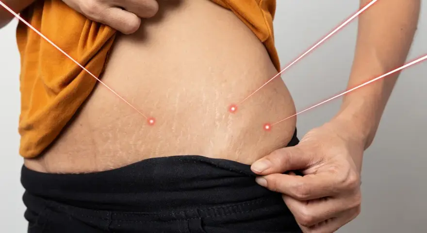 Skóra z widocznymi rozstępami, na którą skierowane są czerwone linie laserowe. Rozważ retinol na rozstępy dla poprawy wyglądu.