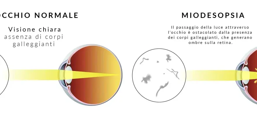 Confronto occhio normale e miodesopsia: corpi galleggianti nel vitreo ostacolano la luce. Ricerca cure naturali per il distacco del vitreo.