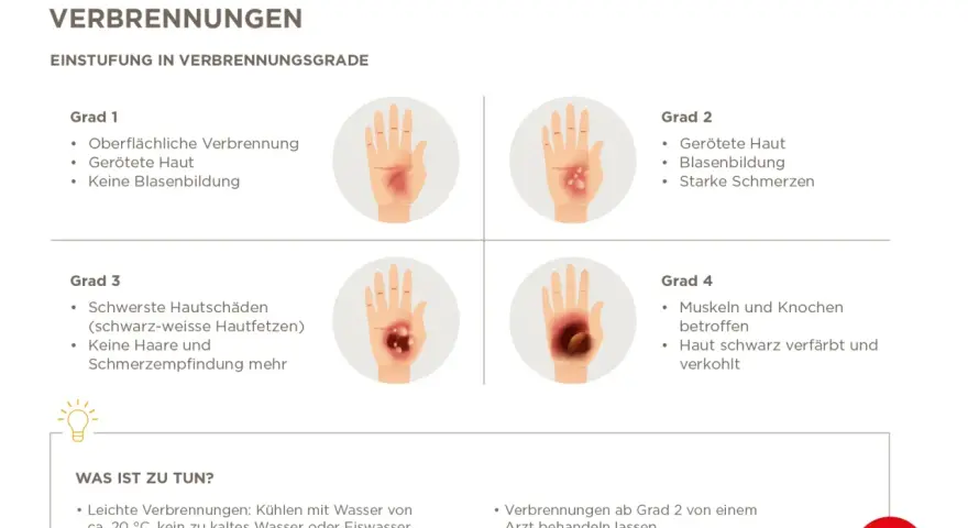 Verbrühungen: Grad 2 zeigt gerötete Haut, Blasenbildung und starke Schmerzen. Ein Arzt sollte ab Grad 2 konsultiert werden.