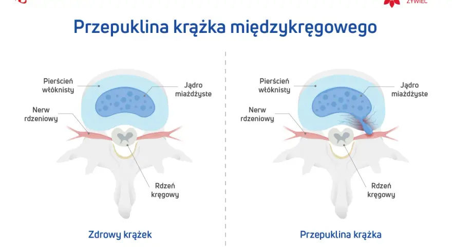 Porównanie zdrowego krążka międzykręgowego z przepukliną krążka szyjnego z uciskiem na worek oponowy.