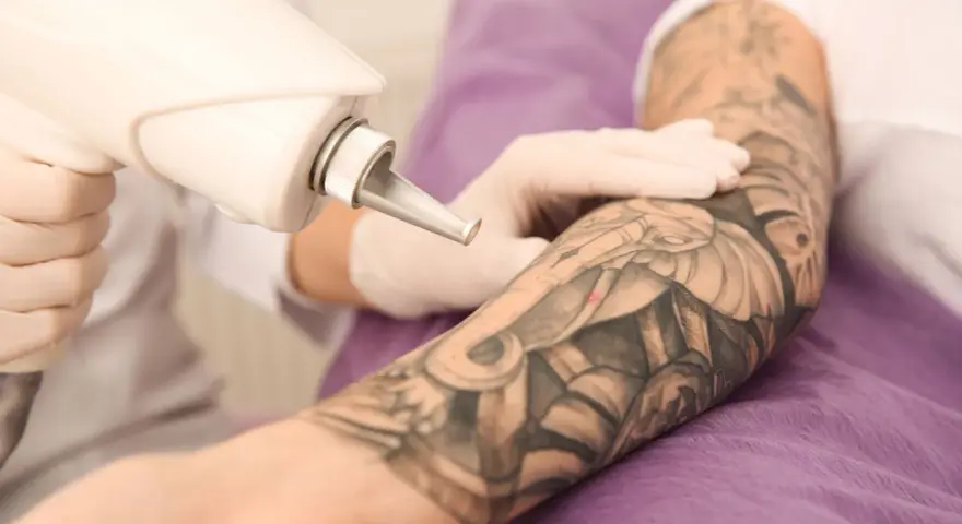 Ręka w rękawiczce trzyma laser do usuwania tatuażu z ręki.