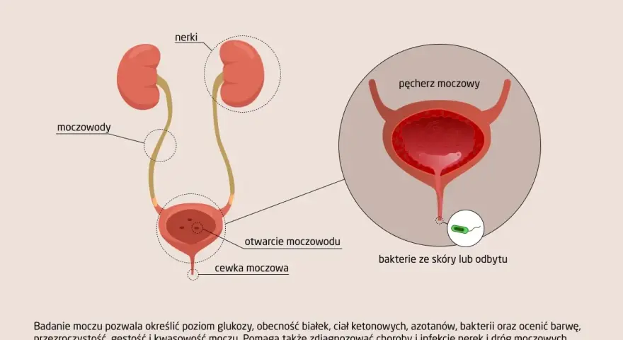 Ilustracja układu moczowego z zaznaczonymi nerkami, moczowodami i pęcherzem. W powiększeniu widoczne bakterie w moczu.