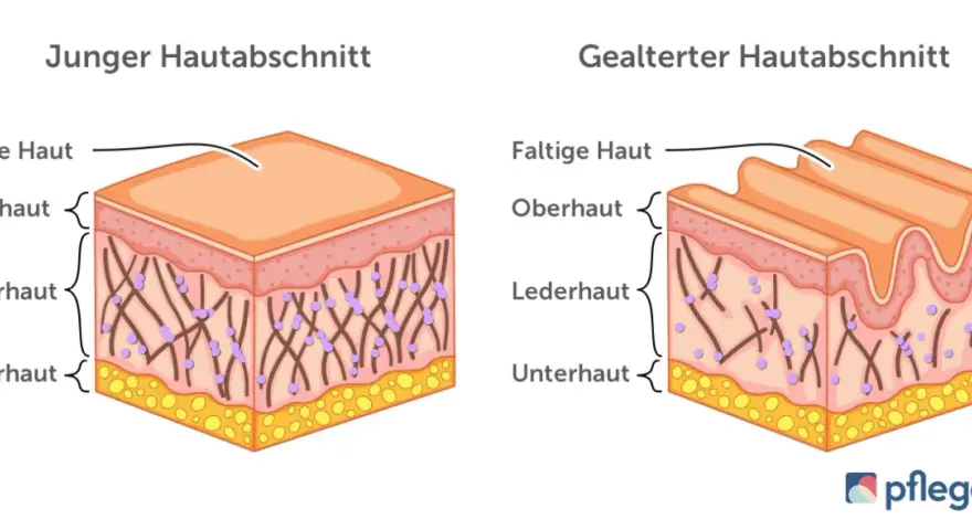 Vergleich von junger, glatter Haut und gealterter, faltiger Haut. Die Lederhaut zeigt bei trockene Haut im Alter weniger Kollagenfasern.