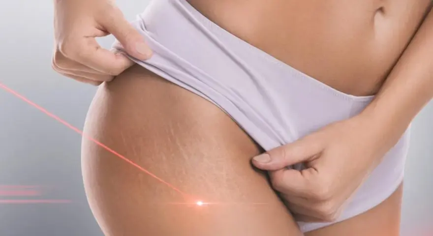 Skóra z widocznymi rozstępami, na którą skierowane są czerwone linie lasera. Zabieg laserowe usuwanie rozstępów.