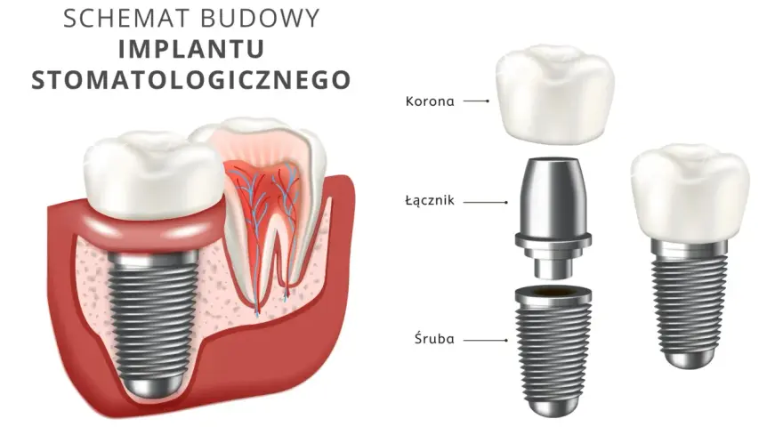 Koszty implantu zęba w Polsce: Pełny przewodnik i jak oszczędzić?