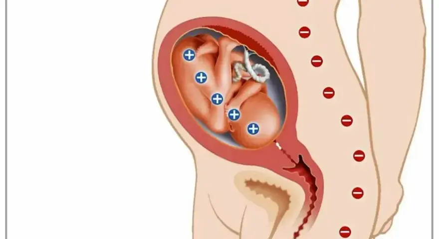 Ilustracja pokazuje płód w macicy z oznaczeniami "+" na ciele, co symbolizuje konflikt serologiczny. Matka ma oznaczenia "-" na kręgosłupie.