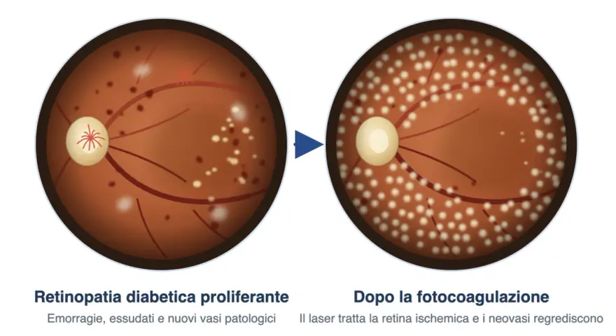 Retinopatia diabetica proliferante con emorragie e essudati, prima e dopo il trattamento laser che riduce la lesione retinica.