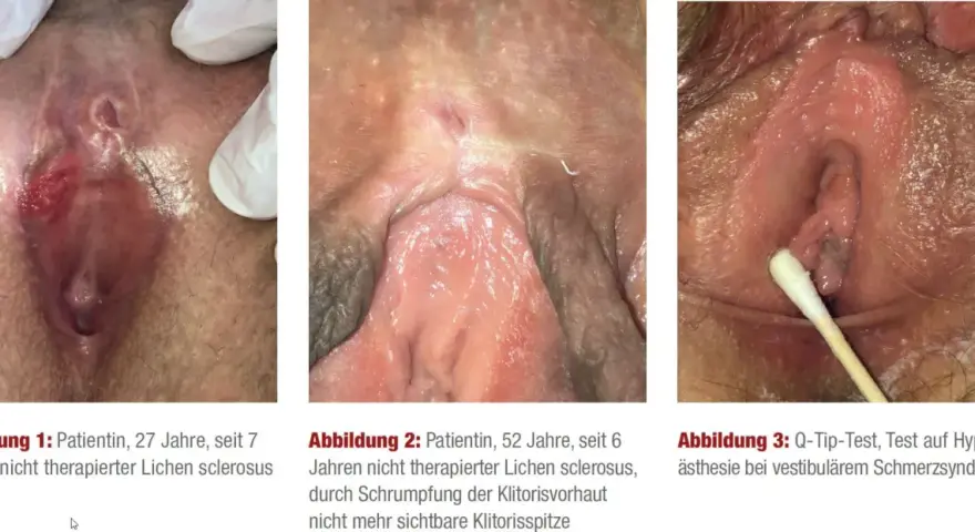 Drei Bilder zeigen die Auswirkungen von Lichen sclerosus: eine entzündete Vulva, eine geschrumpfte Klitoris und einen Q-Tip-Test.