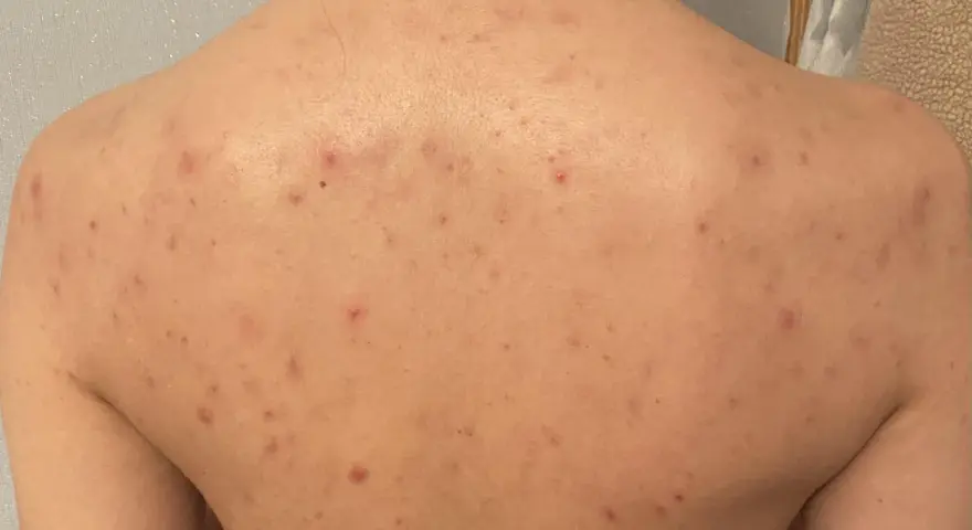 Rygg med utslag av akne på kroppen. Röda prickar och fläckar syns över hela ryggen.