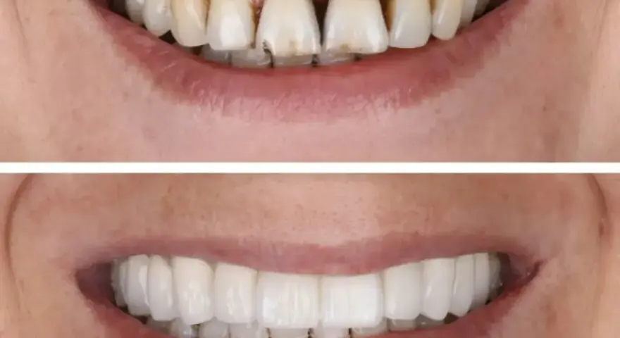 Uśmiech przed i po zabiegu **dental bonding**. Widać znaczną poprawę wyglądu zębów, które stały się białe i równe.