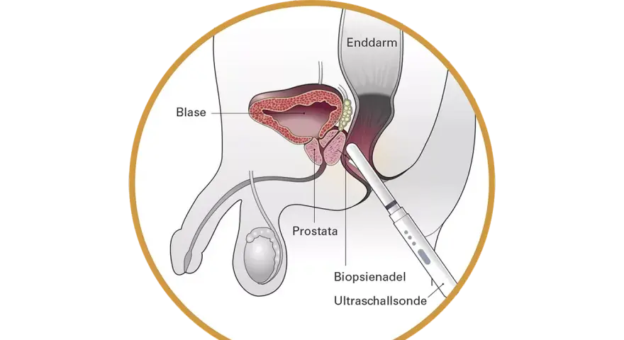 Prostata-Vorsorge ab 30: Wann ist sie wirklich nötig?