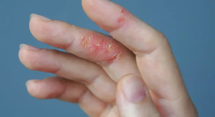 Dedos con piel irritada y escamosa, indicando un fuerte picor en las manos.