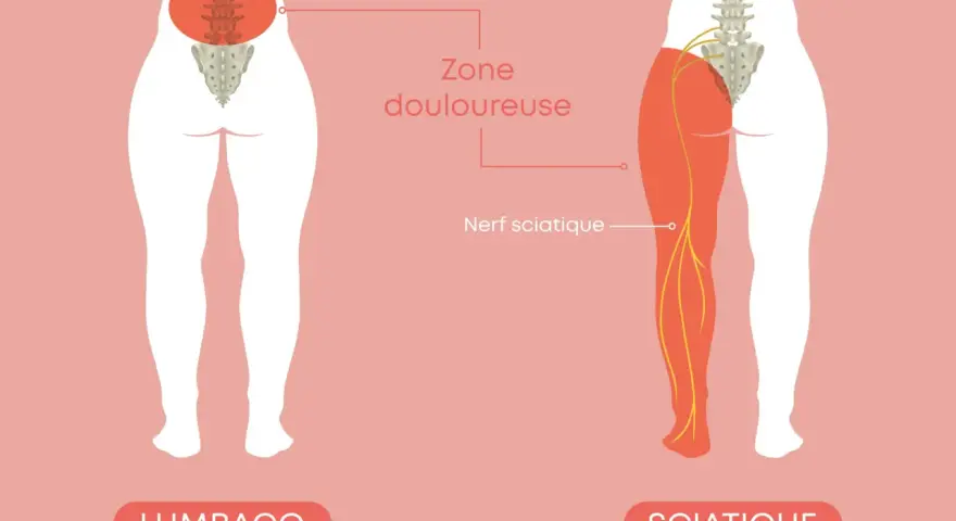 Illustration comparant le lumbago et la sciatique. La sciatique, combien de temps dure-t-elle ? Le nerf sciatique est montré irradiant dans la jambe.