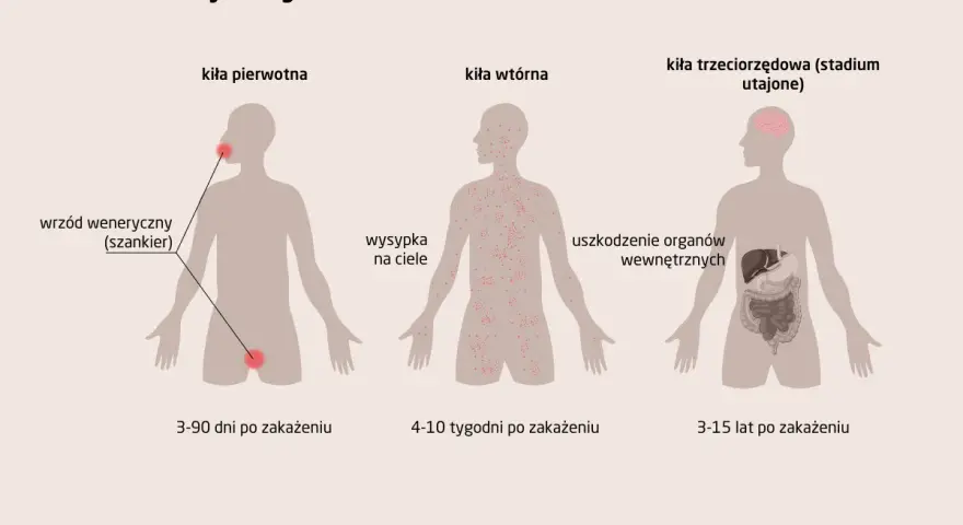 Ilustracja przedstawia stadia rozwoju kiły: pierwotna (wrzód), wtórna (wysypka skórna) i trzeciorzędowa (uszkodzenia narządów).