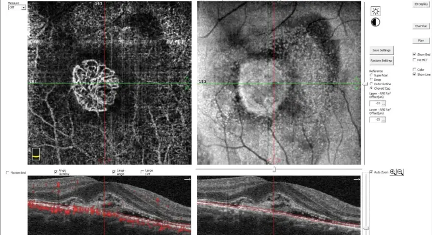 Immagine OCT di un occhio destro, mostra un ispessimento retinico con neovascolarizzazione coroideale, possibile causa di problemi visivi.