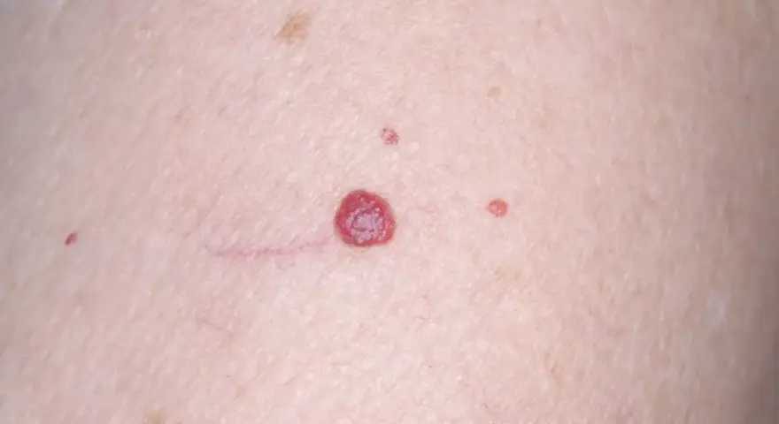 Piel con varios lunares rojos de diferentes tamaños, algunos pequeños y otros más prominentes, junto a finas venas.