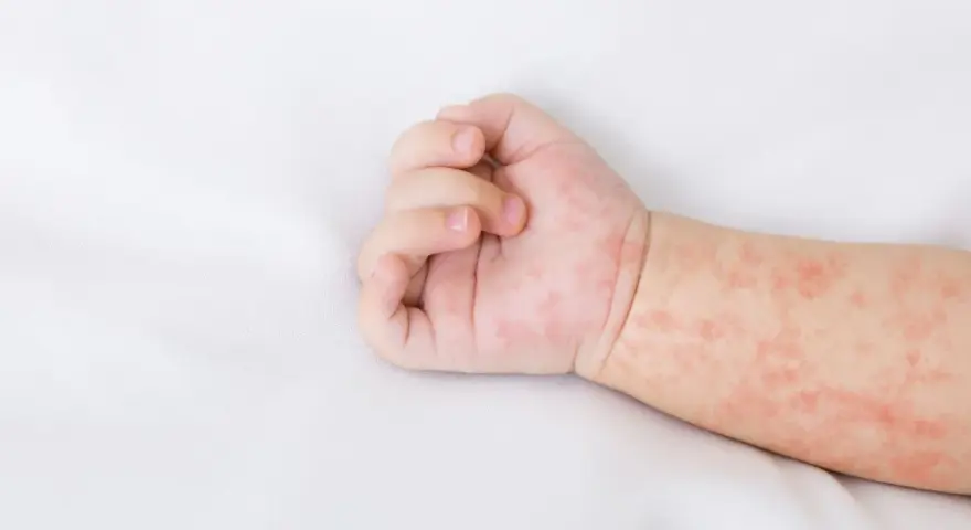 Jak wygląda alergia u niemowlaka? Objawy, które musisz znać