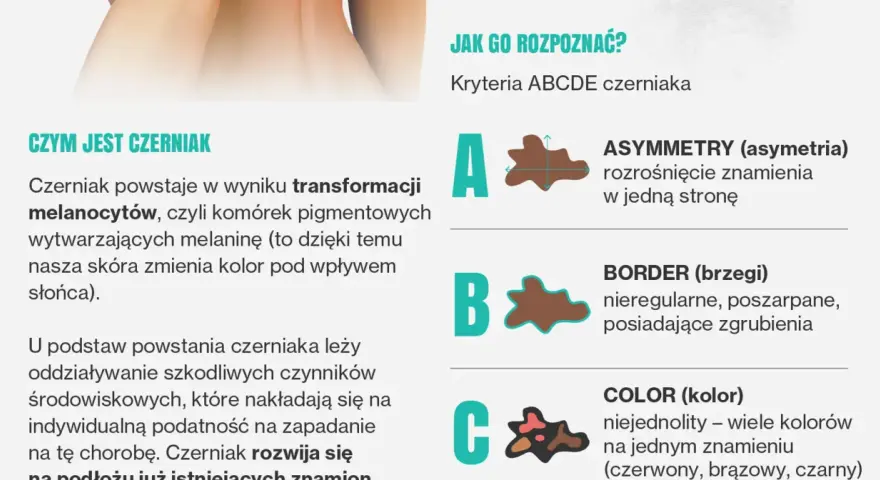 Jak rozpoznać czerniaka? Poznaj kryteria ABCDE: asymetria, brzegi, kolor, średnica i ewolucja znamienia. Dbaj o swoją skórę!