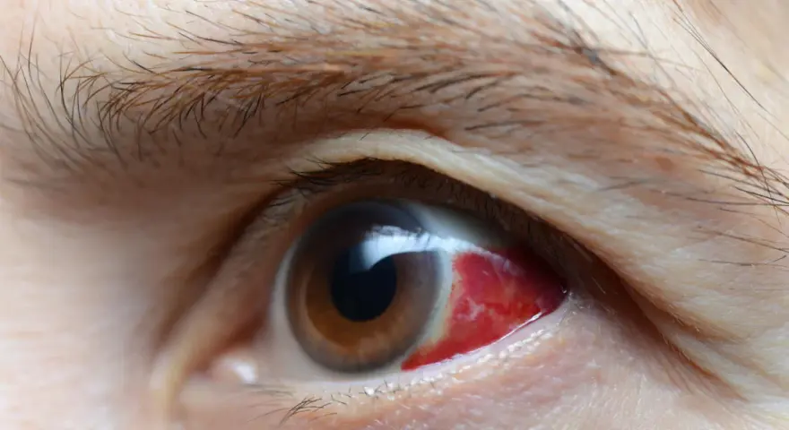 Occhio con forte arrossamento, possibile sintomo di complicanze del diabete.