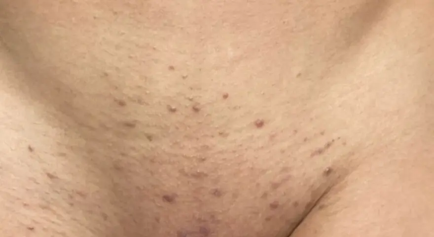 Red bumps and irritation on the skin, indicative of folliculitis and a histamine reaction after waxing.