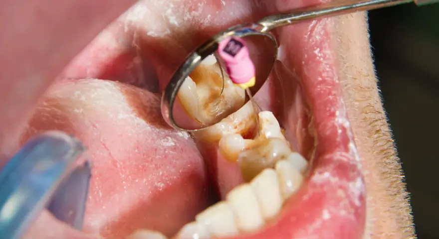 Dentysta używa narzędzia do leczenia zęba, co na bolący ząb?