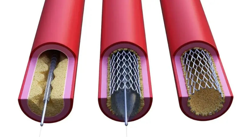 Zatkany stent objawy: niebezpieczne sygnały, które musisz znać