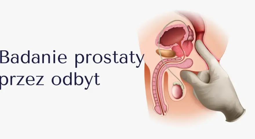 Ilustracja anatomiczna męskiego układu rozrodczego z palcem w rękawiczce badającym prostatę przez odbyt.