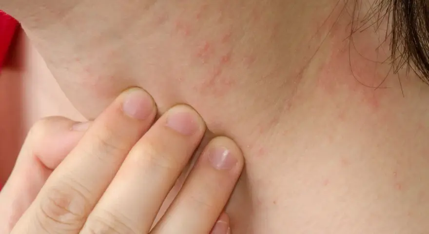 Delikatne plamy wątrobowe na szyi, widoczne pod palcami, sugerują potrzebę konsultacji dermatologicznej.