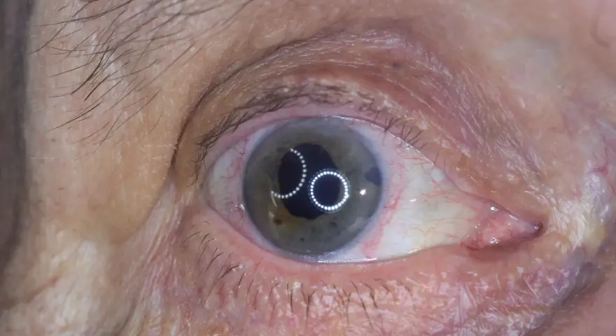 Occhio con iride verde-grigia e riflessi luminosi. Si nota una piccola apertura nell'iride, tipica di un intervento di iridectomia cos'è.