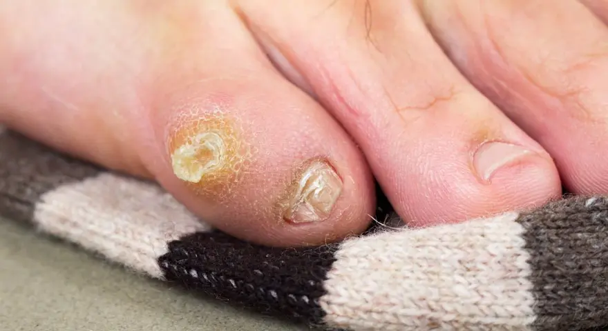 Un oignon au pied, un remède de grand-mère à base d'oignon pourrait aider. Gros plan sur un orteil avec un cor et un ongle abîmé.