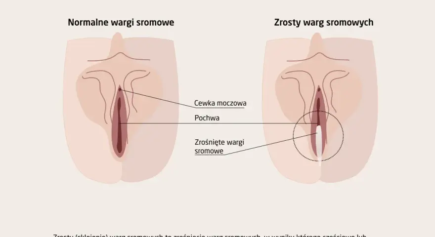 Ilustracja pokazuje, jak wygląda cipa: normalne wargi sromowe i zrośnięte wargi sromowe, które mogą częściowo lub całkowicie zamykać wejście do pochwy.