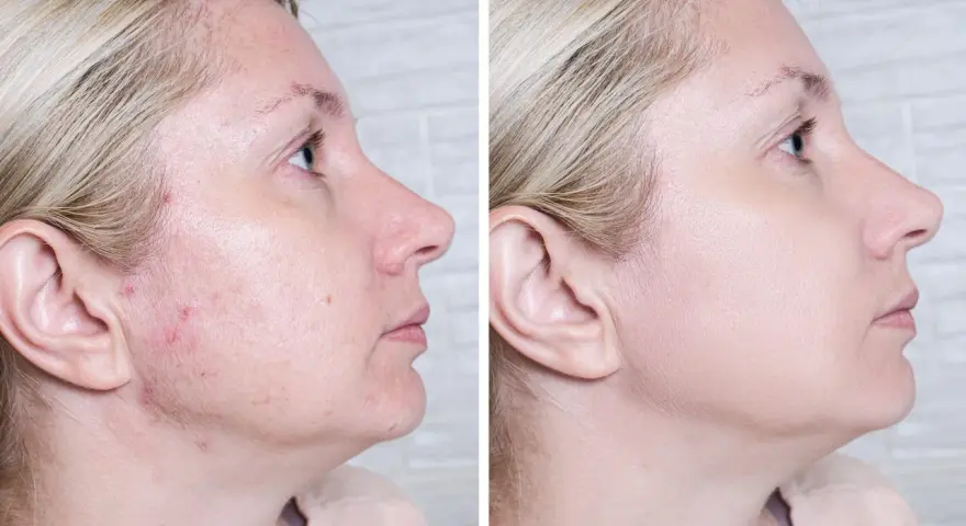 Przed i po: skóra z niedoskonałościami i zaczerwienieniami (acne) po zastosowaniu produktu, który wyrównał koloryt i wygładził cerę.