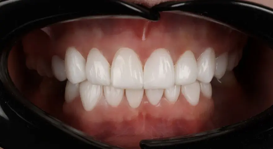 Piękne, białe zęby po zabiegu dental bonding. Uśmiech jak z reklamy!