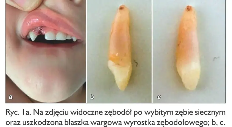 Dziecko z uszkodzonym zębodołem po wybitym zębie mlecznym. Widoczny ruszający się ząb mleczny po uderzeniu.