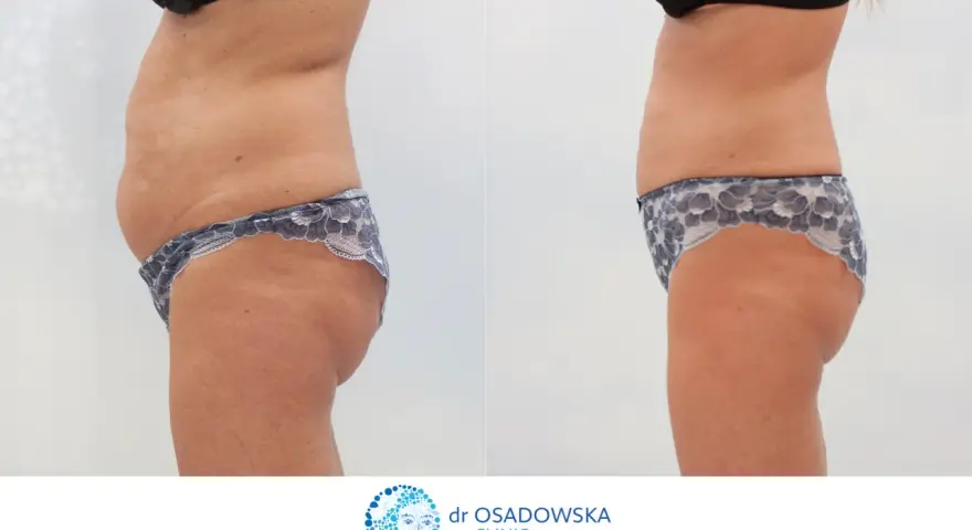 Przed i po zabiegu liposukcji laserowej. Widoczna redukcja tkanki tłuszczowej na brzuchu i biodrach. Opinie pacjentek potwierdzają skuteczność.